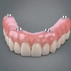 All-on-4 Implants