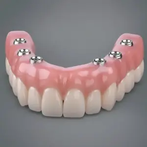 All-on-6 Implants
