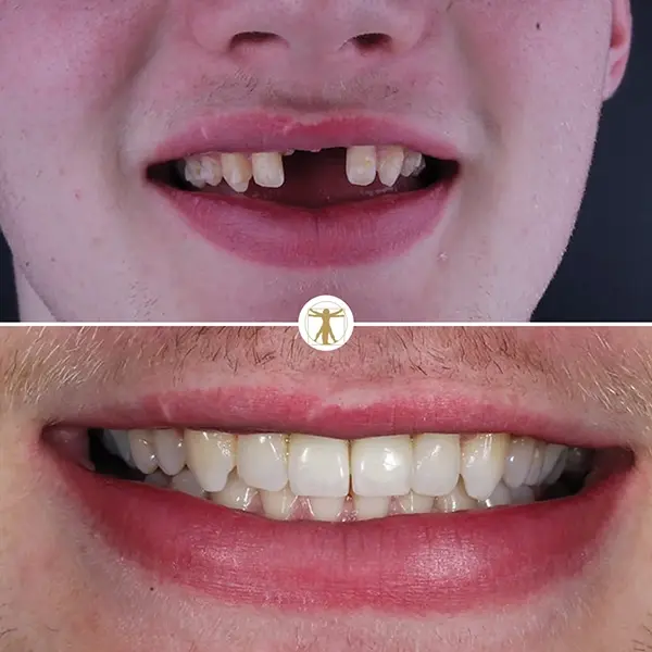 Same Day Hygiene Visit