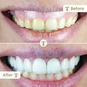 Gum Contouring Before and After