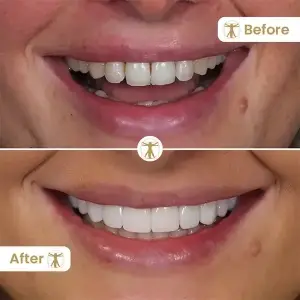 Composite Bonding