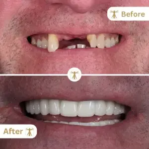 Dental Implants