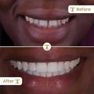 Invisalign
