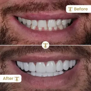 Porcelain Veneers