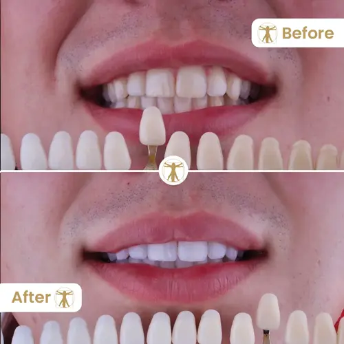 Professional teeth whitening results